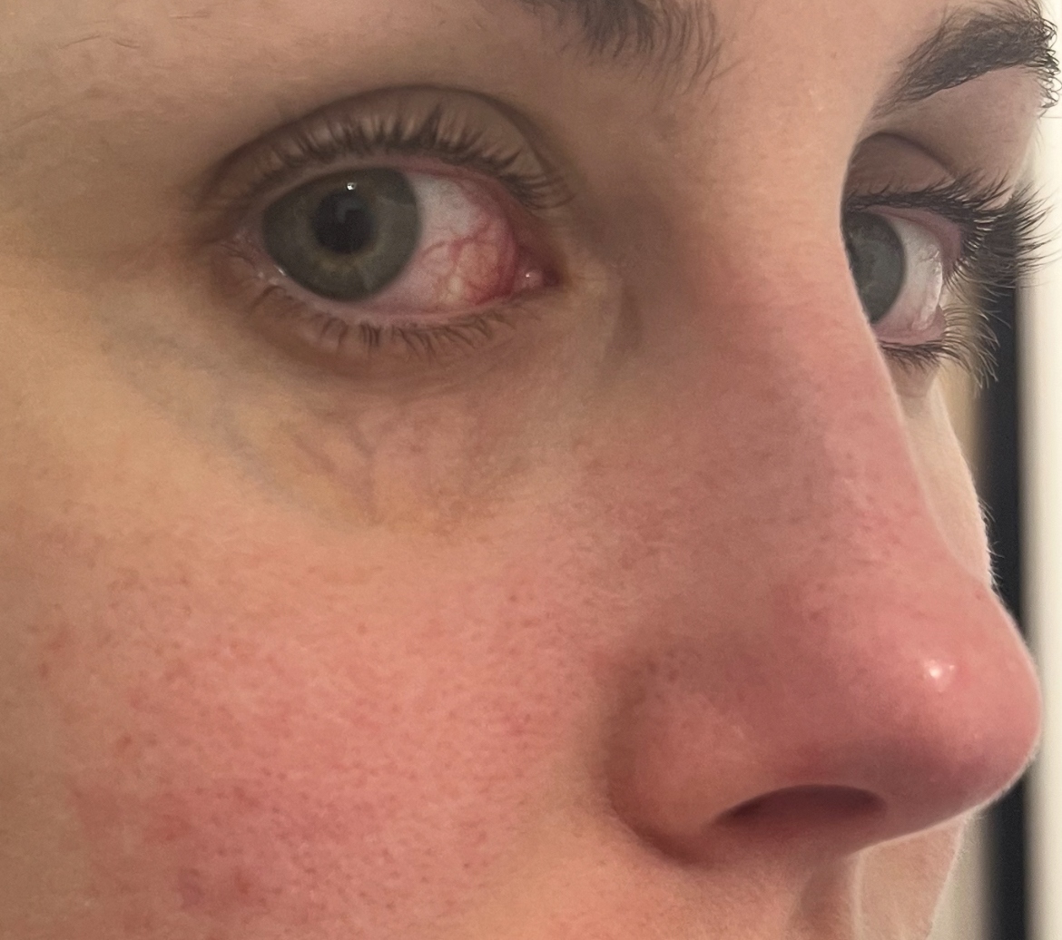 Eye – dilated blood vessels